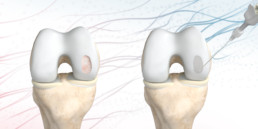 Raupe Designstudio: 3D-Visualisierung Knorpeldefektbehandlung Übersicht