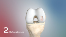 3D-Visualisierung eines Knorpels mit gereinigtem Defekt