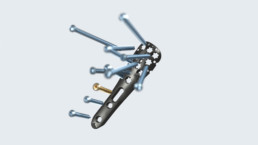 Animierte OP-Anleitung der Firma Königsee Implantate: Implantat Humerus Platte mit reinfliegenden Schrauben