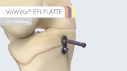 Animierte OP-Anleitung der Firma Königsee Implantate: Implantat EPI-Platte mit reinfliegenden Schrauben