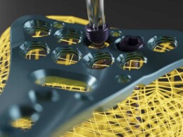 Raupe Designstudio: Darstellung Implantat Radiusplatte auf einem leuchtenden Wirframe Knochen mit Schrauben und Shcraubendreher Close-Up