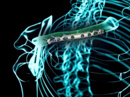 Anatomische Dartstellung: mit dem Produkt Klavikulaplatte